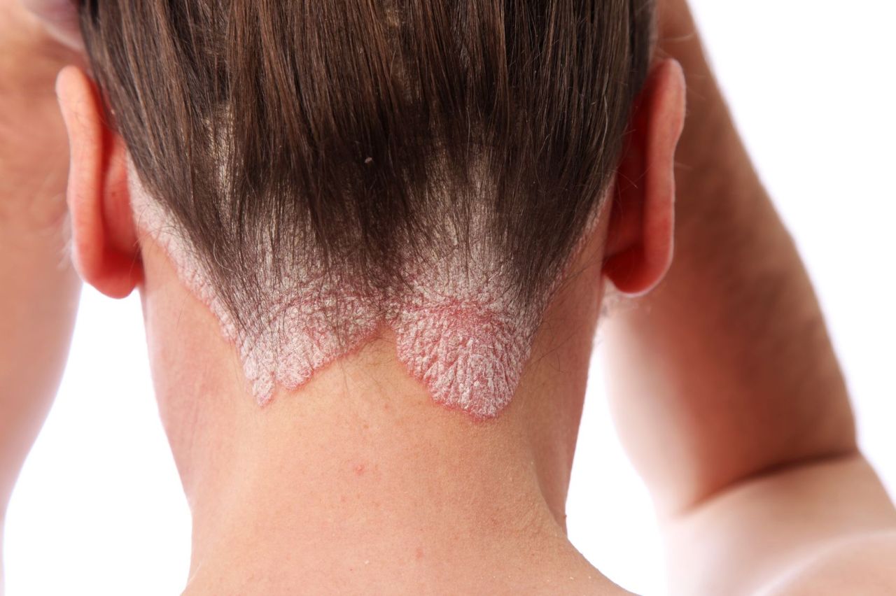 Comment guérir un psoriasis du cuir chevelu ?